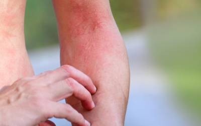 Taming the Itch: A Homeopathic Guide to Poison Ivy Relief