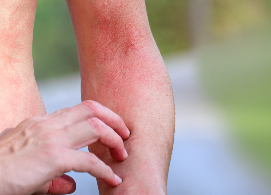 Taming the Itch: A Homeopathic Guide to Poison Ivy Relief