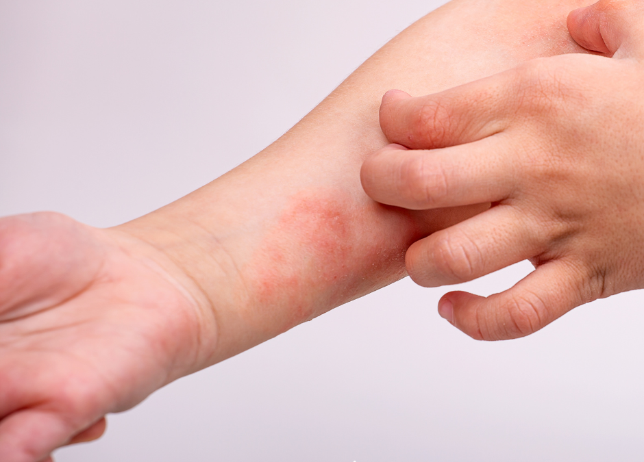 Restoring Balance to Eczema Prone Skin